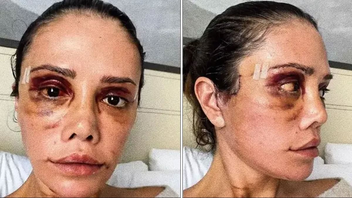 İkinci yüz naklinin ardından felç geçiren Didem Ceran, yeni tedavi sürecine giriyor